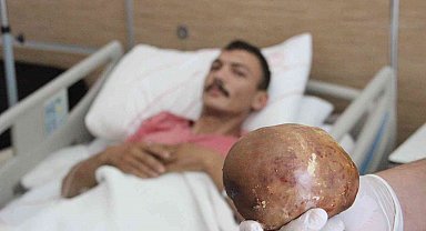 Hastaneye başvuran hastanın mesanesinden 1 kilo taş çıktı