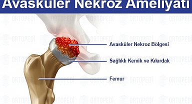 Avasküler Nekroz: Kemik Sağlığınız İçin Bilmeniz Gereken Her Şey